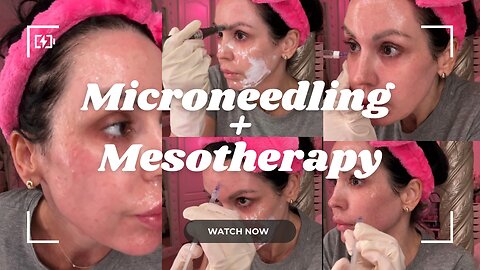Microneedling + Mesotherapy for face and under eye