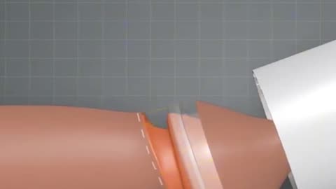 How ZSR Circumcission Surgery Is Performed (3D Animation)