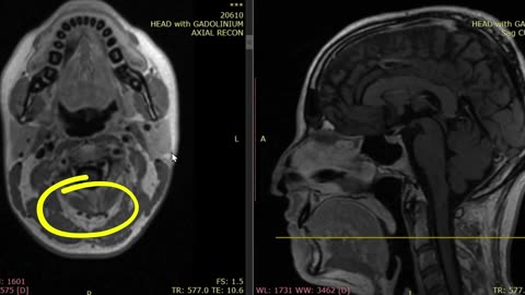 Radiology miss - Fatty infiltration (atrophy) in the upper cervical spine MRI