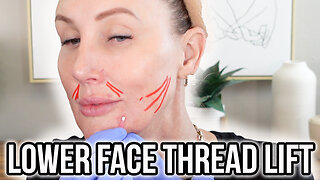 Lower Face Thread Lift + Marionette Lines & Nasal Labial Folds