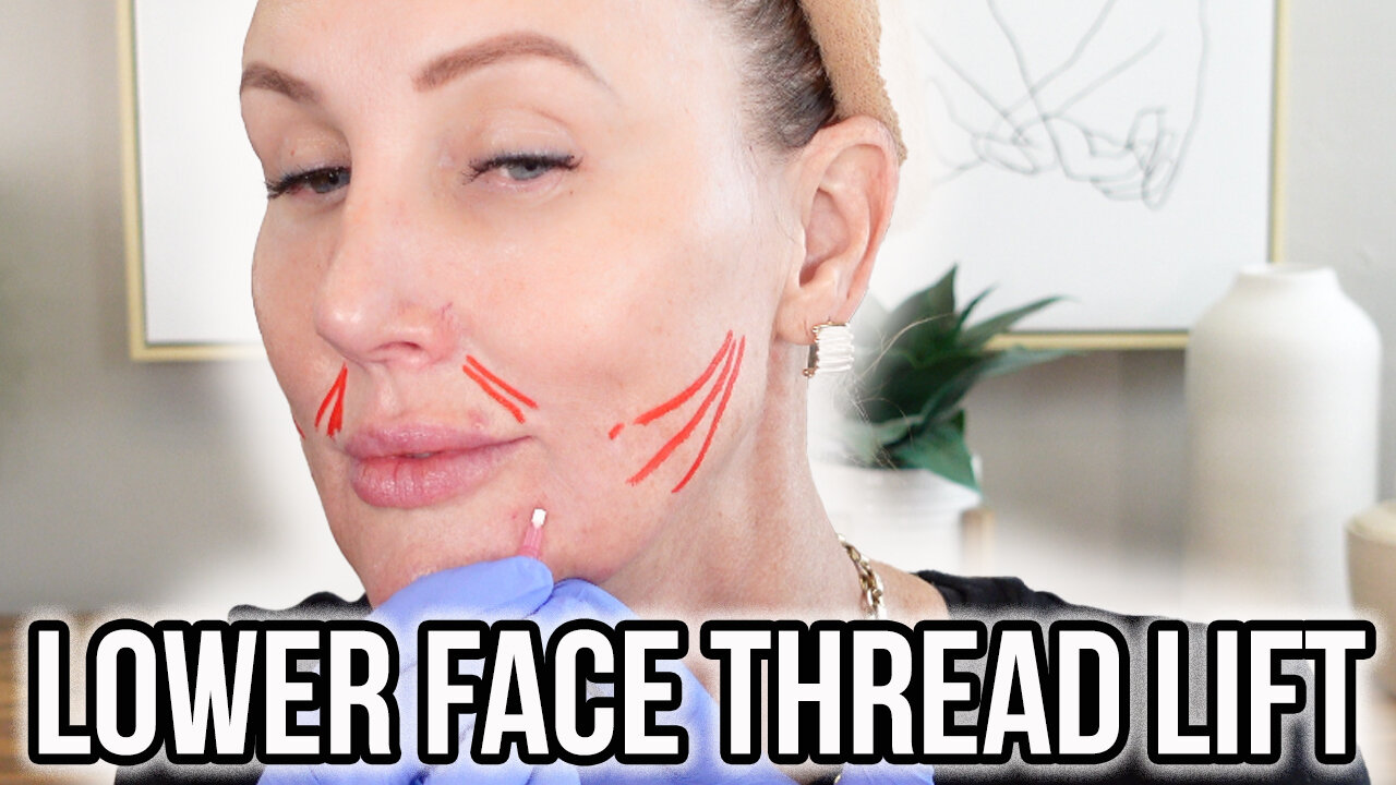 Lower Face Thread Lift + Marionette Lines & Nasal Labial Folds