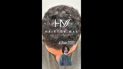 Before & After PRP