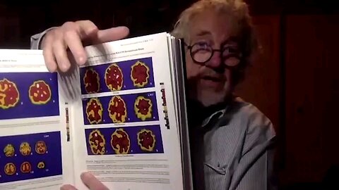 The Clinical and Scientific Basis of Myalgic Encephalomyelitis and Chronic Fatigue Syndrome 1992 Hardback Book and the effects of Exertion seen on XENON SPECT Scans - Byron Hyde, MD