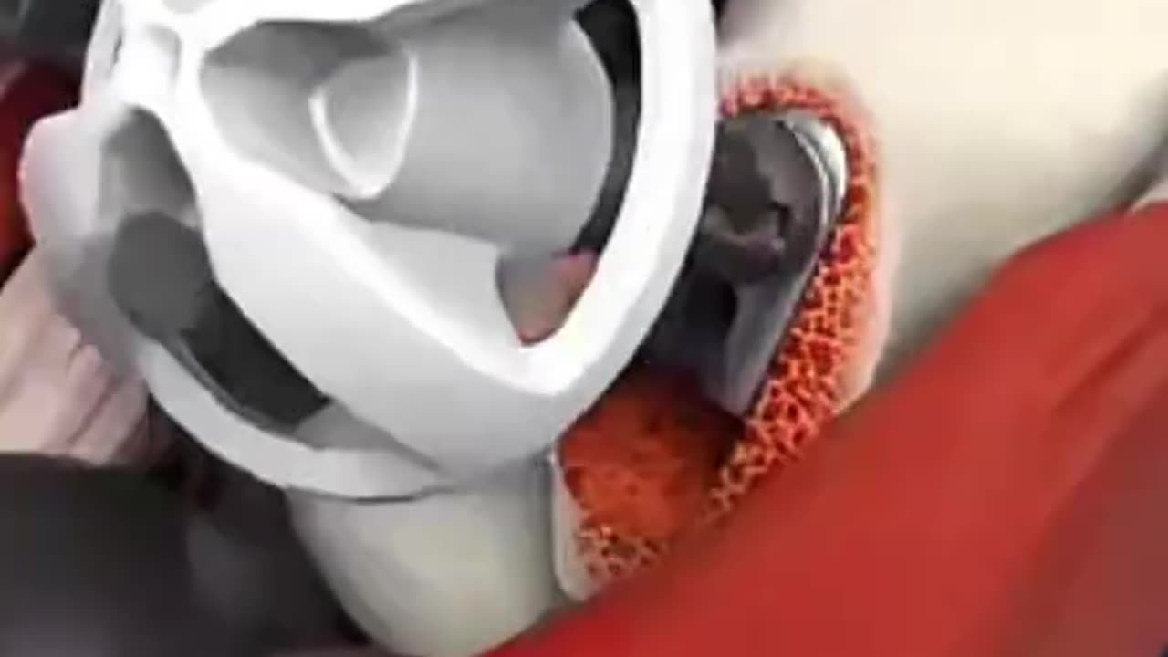 Ever Wondered How Total Hip Replacement Is Done