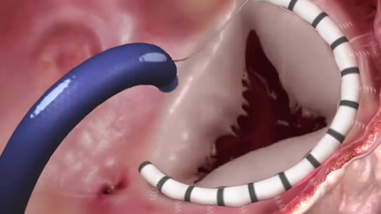 Heart Cardioband Tricuspid System 3D Animation