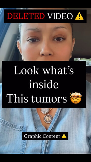 DELETED VIDEO 😡 Look what's inside This tumors ⚠️ Graphic Content