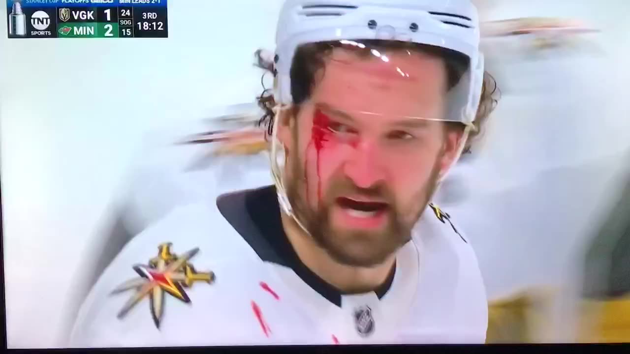 VGK #61 Mark Stone Eye 👁 injury 🤕