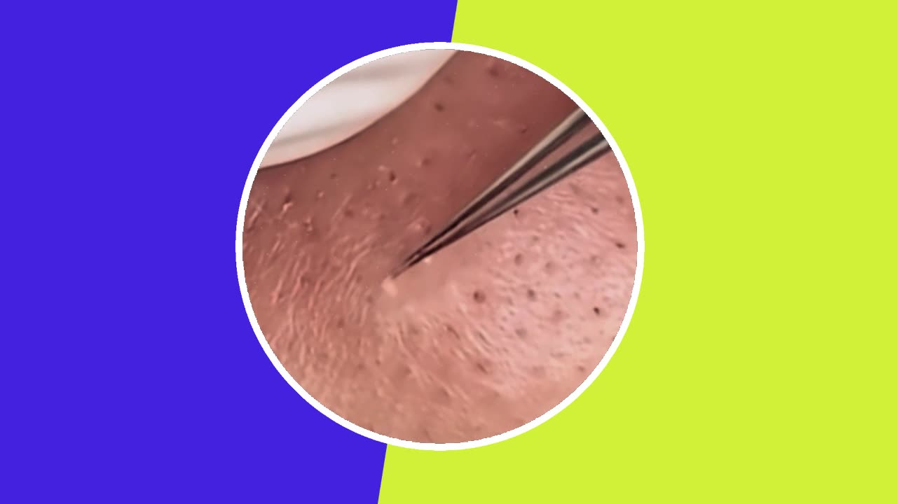 【毛穴 角栓 美容医療】Pimple Removal Satisfying Video (ASMR) #1