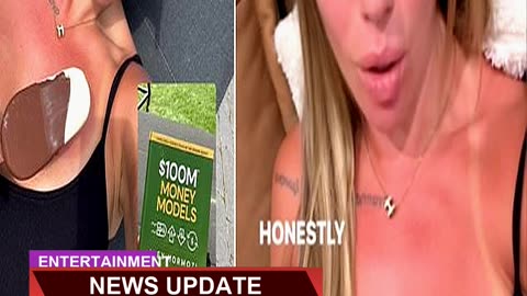 Holly Hagan Displays Her Sunburnt Chest as She Spe