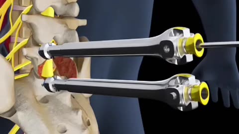 Lumbar Fusion Surgery Explained - Spinal Stability & Pain Relief