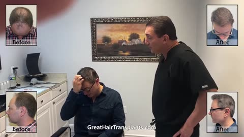 Patient Kyle’s High-Density MaxHarvest™ Hair Transplant