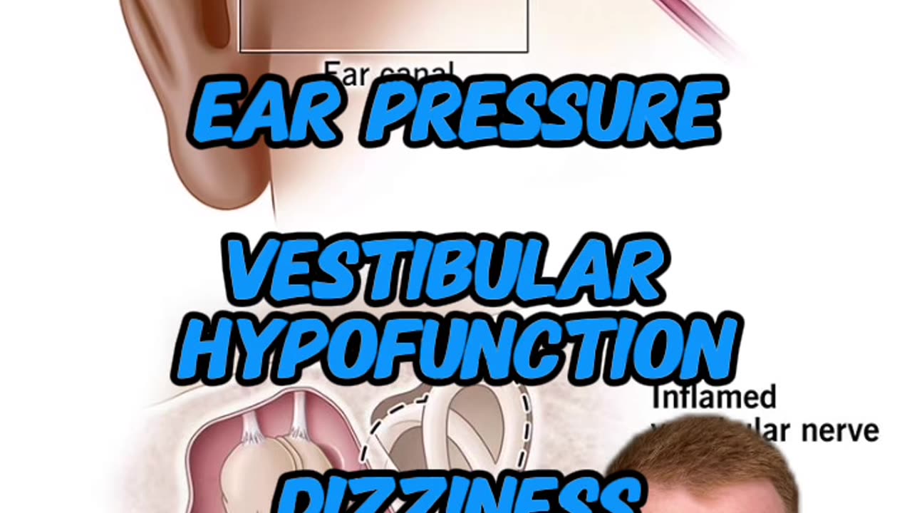 Vestibular disorders and the neck connection | vertigo | menieres| mdds| Neckwise upper cervical