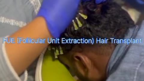 FUE Hair Transplant Explained | Follicular Unit Extraction Treatment by TiaCare.in