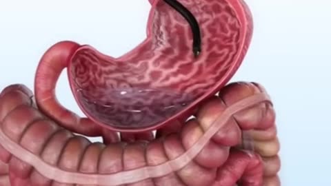 Endoscopic Sleeve Gastroplasty Procedure (3D Animation)