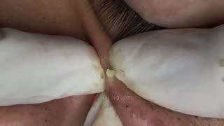 Blackheads Removal & Pimple Popper Cystic Acne Extraction #221