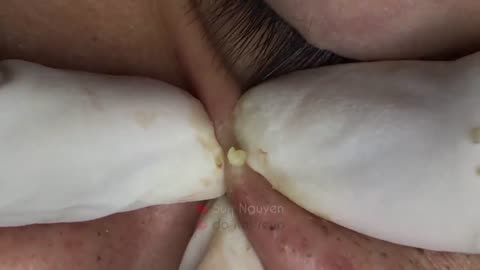 Blackheads Removal & Pimple Popper Cystic Acne Extraction #221