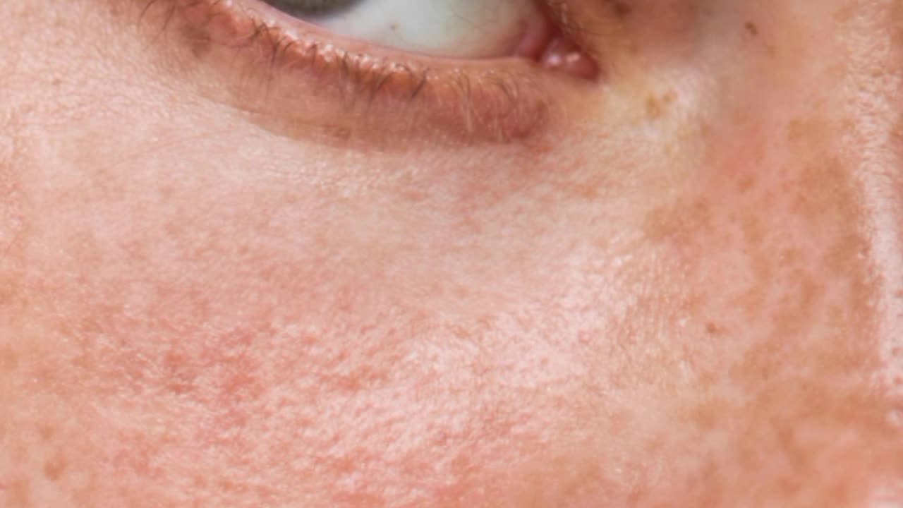El Melasma