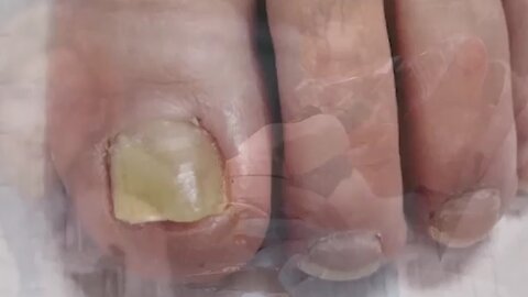A recent discovery, anyone can now fight nail fungus 3X faster, even while sleeping!