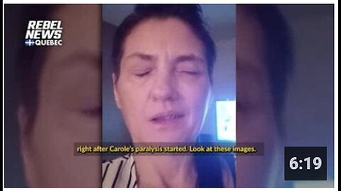 "Carole Avonie: Another Incident of Bell's Palsy Coincidence"