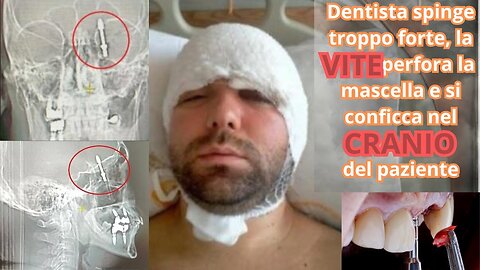 👨‍⚕️🛌Dentista spinge troppo forte, la vite perfora la mascella e si conficca nel cranio del paziente