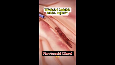 How to open a clogged vein? Trombektemi