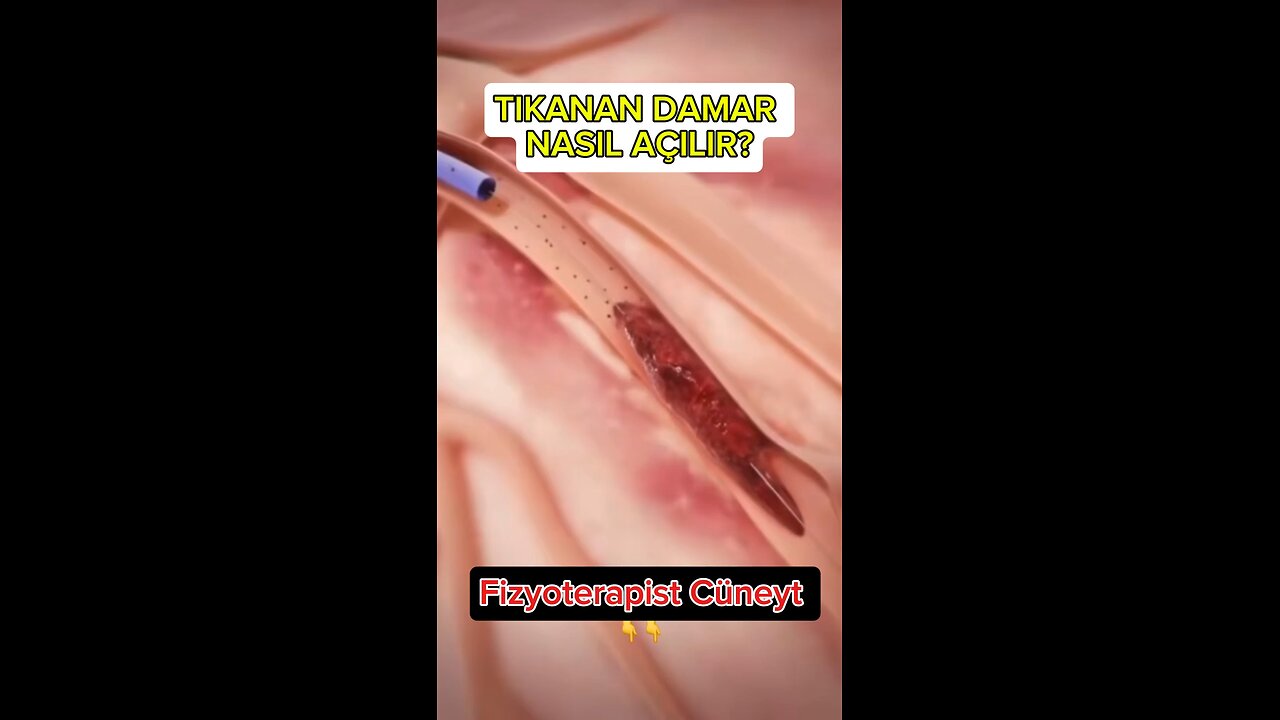 How to open a clogged vein? Trombektemi