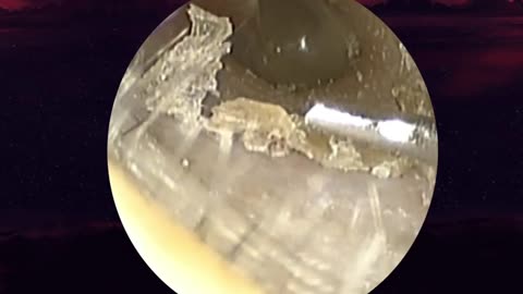 Earwax patches look like nylon