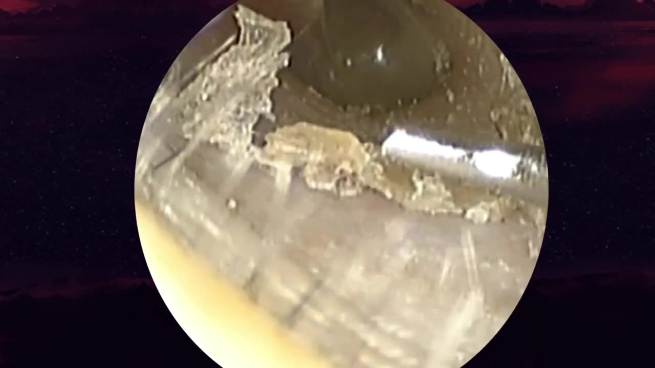 Earwax patches look like nylon