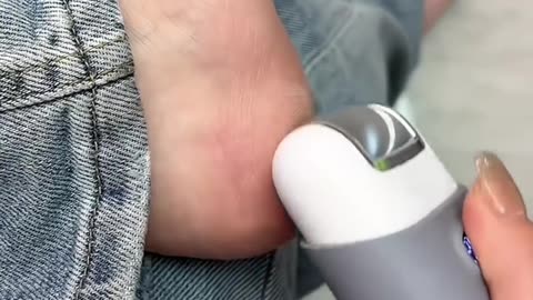 Automatic Callus Remover for Feet, Rechargeable Pedicure Tools for Feet | Amazon gadgets