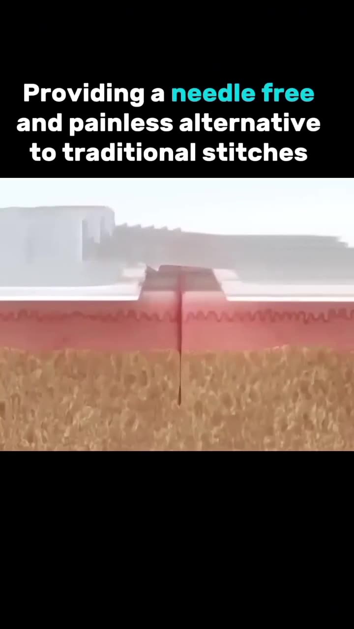 Zipclose the solution to seal wounds without stitches