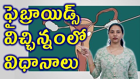 ఫైబ్రాయిడ్స్ విచ్ఛిన్నంలో విధానాలు Types of Painless Faibroids Removal Surgery Laser Myolysis