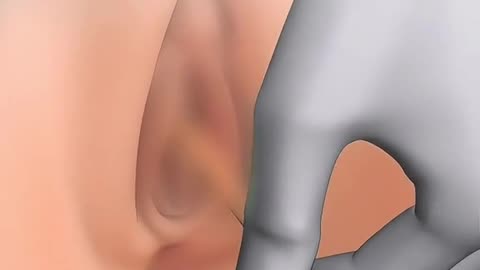 Foley Catheter Procedure (3D Animation)