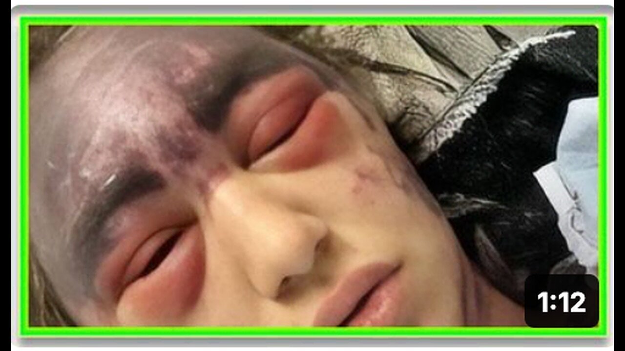 "Woman Severely Affected by Adverse Reaction to Vaccination"