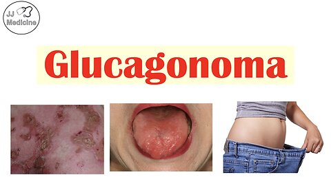 This Rare Tumor Causes Diabetes, Weight Loss, and a Strange Rash - Glucagonoma