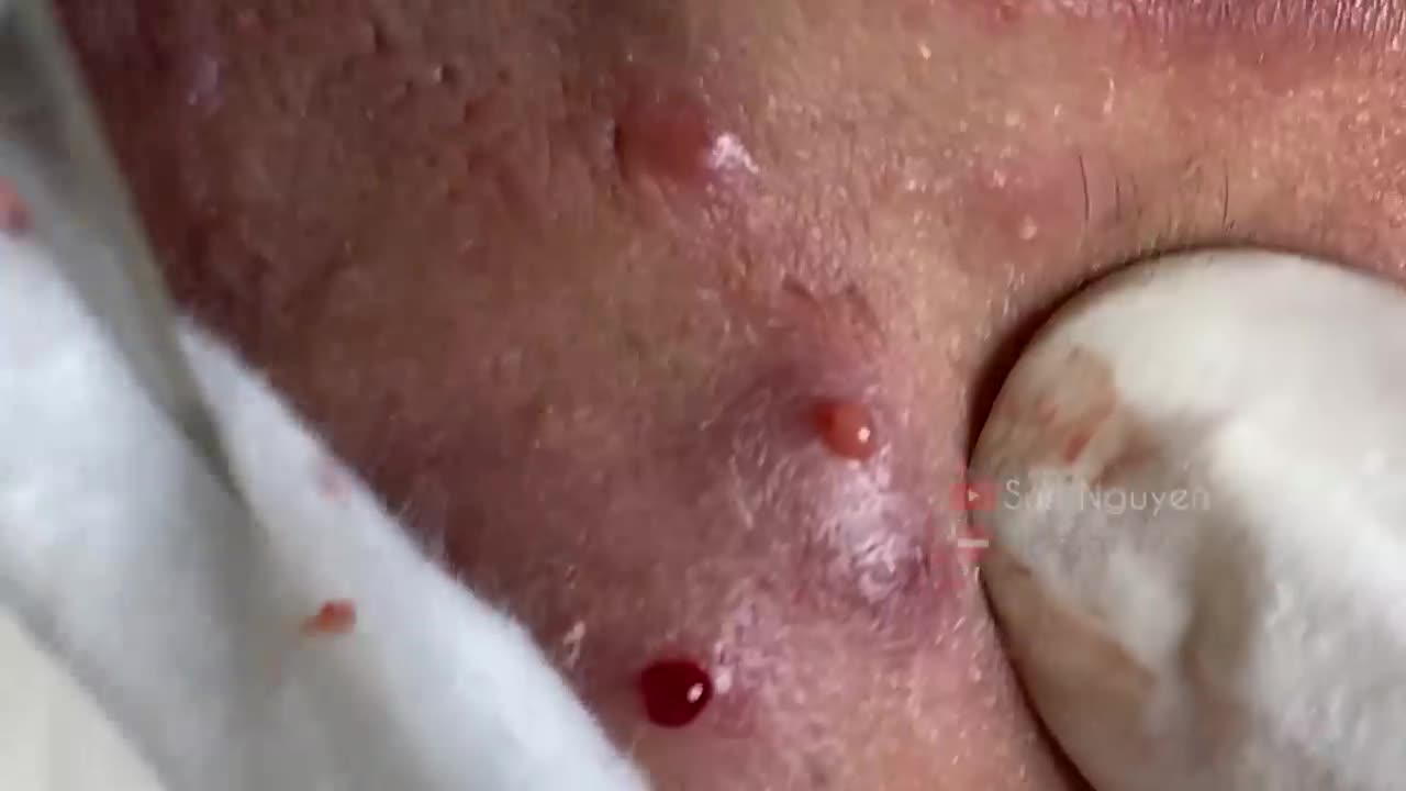 Blackheads Removal & Pimple Popper Cystic Acne Extraction 218