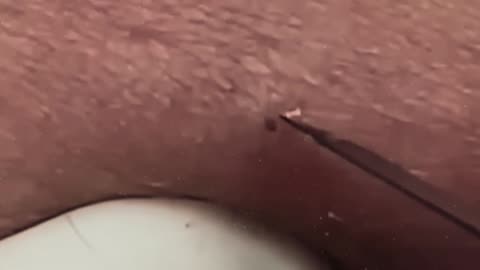 New satisfying blackhead removal #12