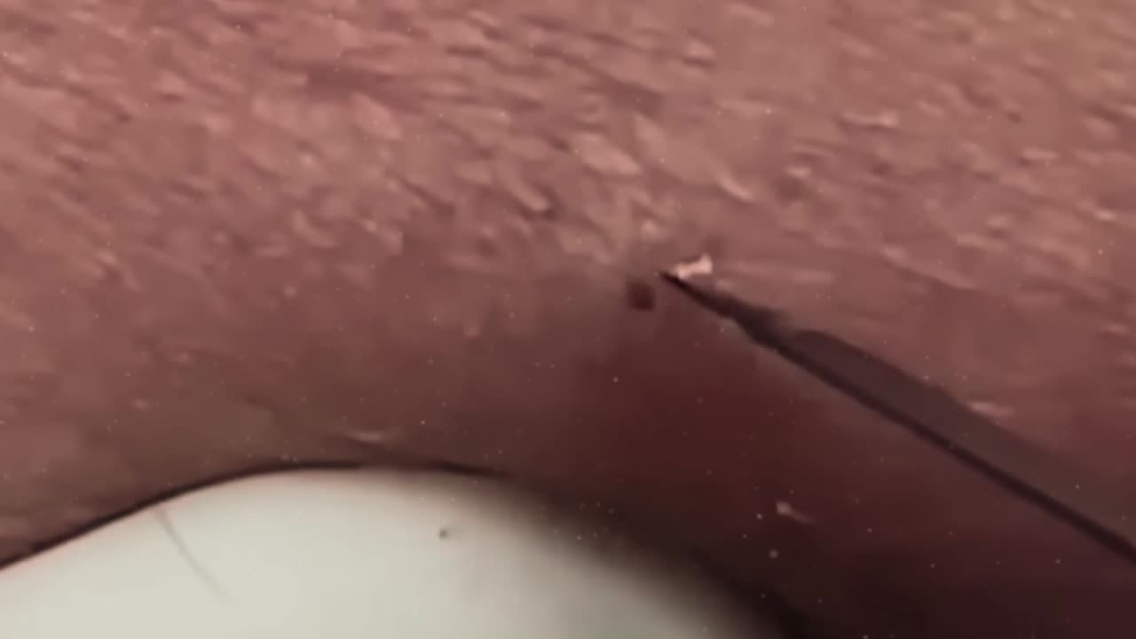 New satisfying blackhead removal (ASMR) #12
