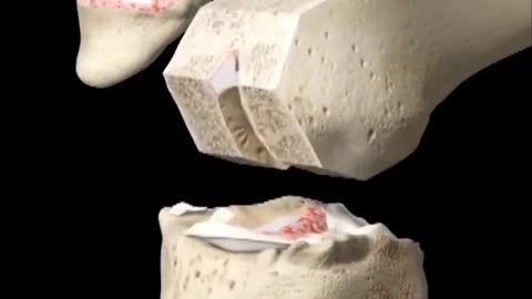 Arthroplasty With Cement 3D Animation