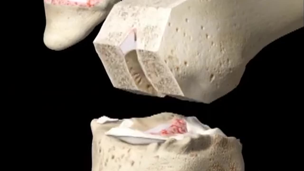 Arthroplasty With Cement 3D Animation