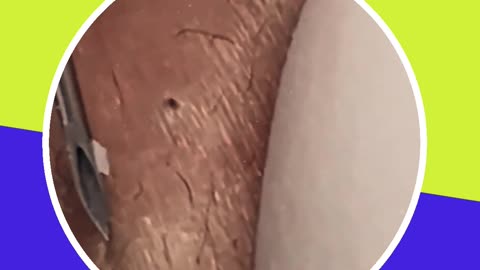 Pimple removal satisfying video (ASMR) #8 #shorts