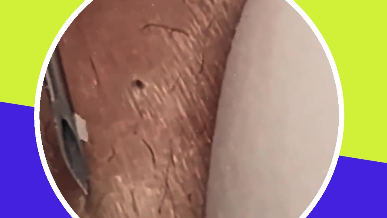 Pimple removal satisfying video (ASMR) #8 #shorts