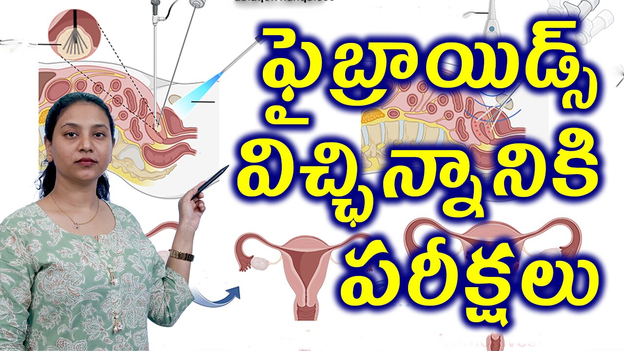 ఫైబ్రాయిడ్స్ విచ్ఛిన్నానికి పరీక్షలు Tests for Painless Faibroids Removal Surgery Laser Myolysis