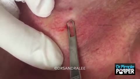 A couple of whiteheads extracted