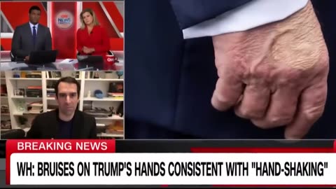What is the spot on President Trump's hand