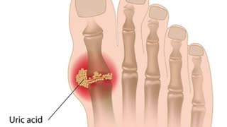 Can Ginger Soothe Gout? The Surprising Truth