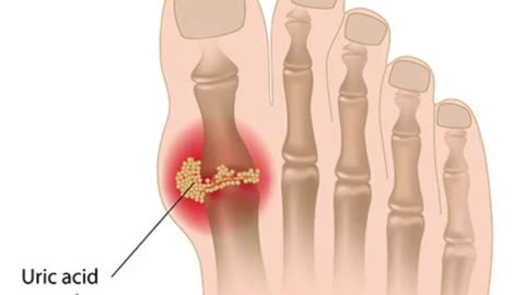 Can Ginger Soothe Gout? The Surprising Truth
