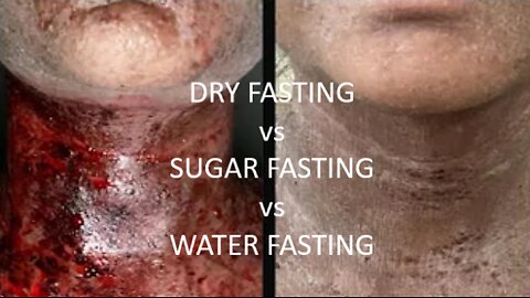 LIVE - DRY FASTING vs SUGAR FASTING vs WATER FASTING Live Weight Loss Q&A