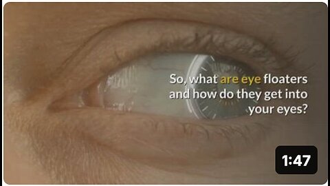 "Natural Treatment: The Cure for Eye Floaters Naturally"