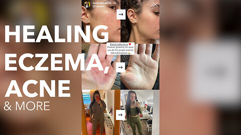 Healing Eczema, Acne & More