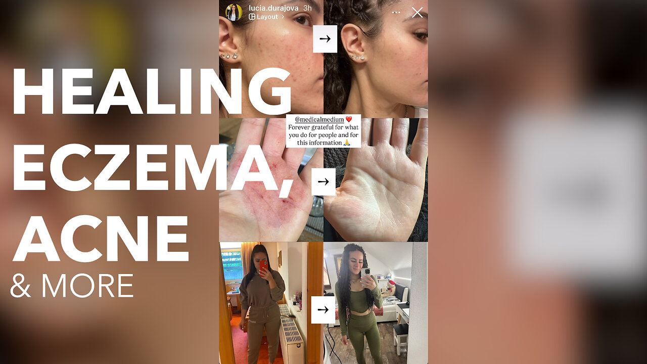 Healing Eczema, Acne & More